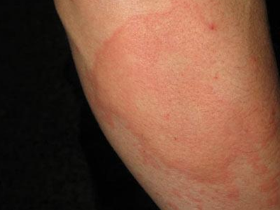 大人風(fēng)疹怎么治療（大人風(fēng)疹的癥狀圖片）