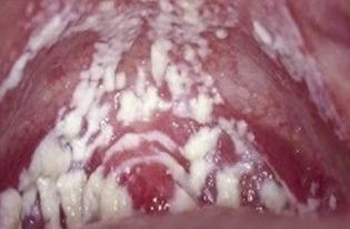 霉菌和滴蟲的區別圖片(霉菌性陰炎嚴重后果)