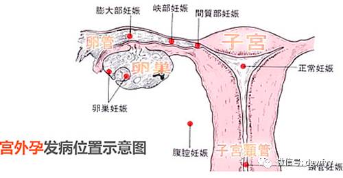 宮外孕腹部疼痛位置圖片(宮外孕腹痛位置圖片)