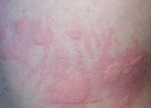 過敏性皮皮炎圖片(過敏性皮炎圖片大全集)