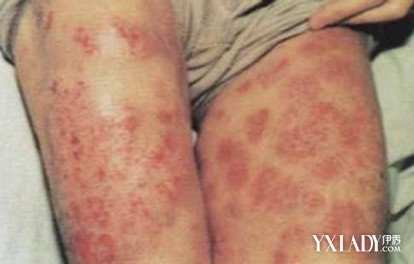 過敏性皮炎怎么根治方法(過敏性皮炎癥狀及治療方法)
