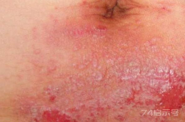 常見的皮膚病圖解(常見的皮膚病癥狀以及圖片)