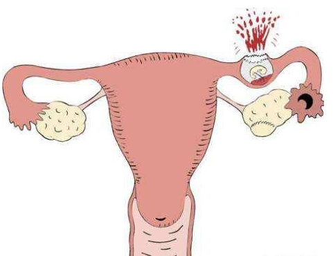 宮外孕的最明顯癥狀(宮外孕最準確癥狀)