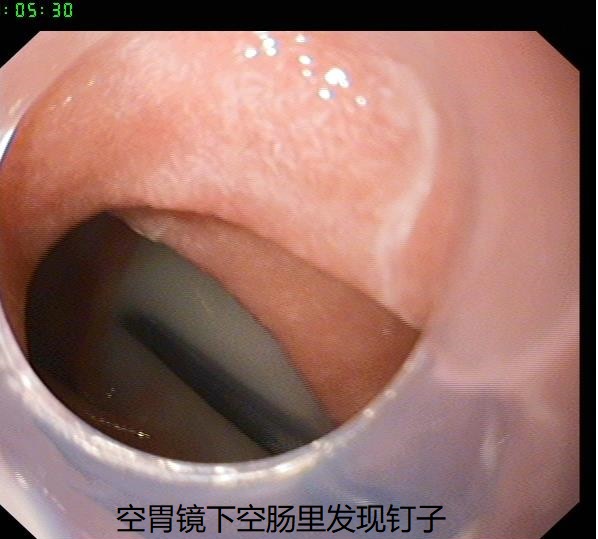 胃鏡怎么做的過程視頻(做胃鏡的全過程圖)