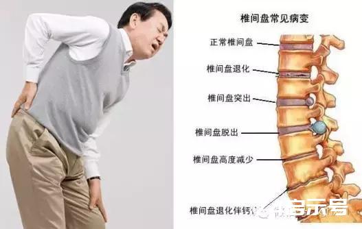 怎樣判斷腰肌勞損還是腰間盤突出需要住院嗎(怎樣判斷腰肌勞損還是腰間盤突出)