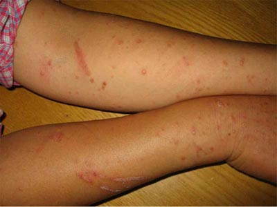 皮膚病癥狀圖片大全圖解(皮膚病癥狀圖片大全)