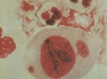 男性感染支原體有什么癥狀表現(感染支原體有什么癥狀表現)