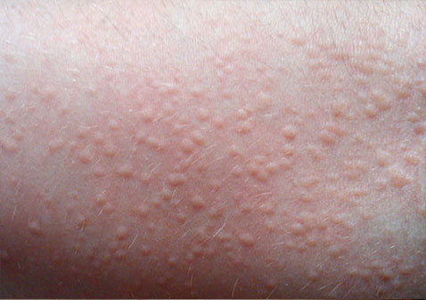 腳上皮膚病種類對照圖片(皮膚病種類對照圖片)