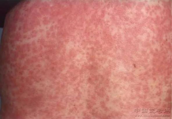 皮膚病圖片對照大全查看圖片(皮膚病圖片對照大全查看圖片皮膚過敏)