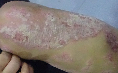 十大最難治的皮膚病(十大最難治的皮膚病魚鱗病圖片大全)