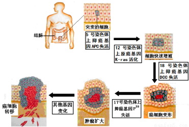 直腸癌是什么原因引起的(直腸癌是什么原因引起的直腸癌好發于哪個年齡階段)
