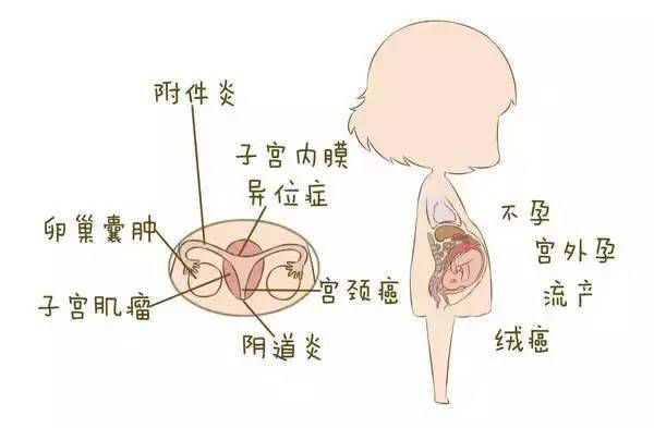 女人的附件炎是怎么引起的(附件炎3個壓痛點圖片)