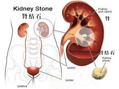 腎結石的早期癥狀(腎結石的早期癥狀表現會腰疼嗎)