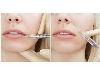 膠原蛋白打一針大概多少錢啊(膠原蛋白注射費用)