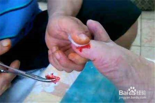 灰指甲怎么治療除根(灰指甲怎么治療除根需要多長時間)