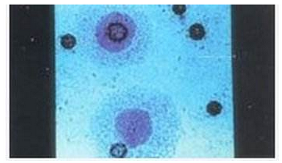 支原體不治療會自愈嗎(肺炎支原體不治療會自愈嗎)