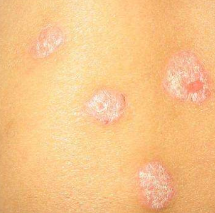 皮炎和癬的區(qū)別圖片(牛皮皮癬早期圖片早期癥狀)