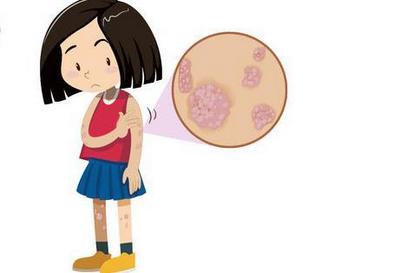 皮膚病照片查病(皮膚病看圖自查)