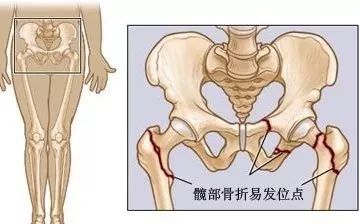 骨頭壞死了還能恢復(fù)嗎(骨頭壞死了還能恢復(fù)嗎中醫(yī))