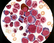 血小板增多癥能治好嗎(基因突變血小板增多癥能治好嗎)