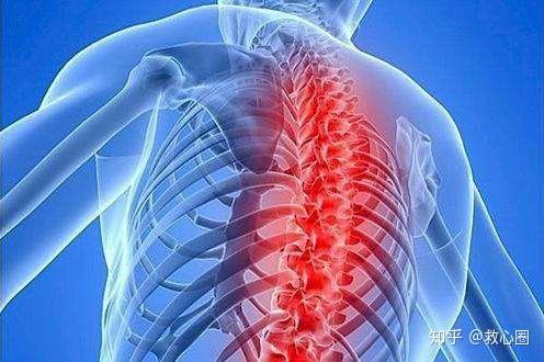 女性強直性脊柱炎的早期癥狀（女性強直性脊柱炎的早期癥狀屁股疼）