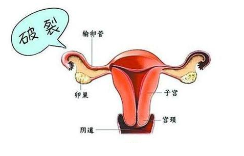 什么人容易得宮外孕(宮外孕)