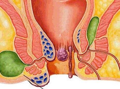 男性肛瘺早期圖片(肛瘺真實(shí)圖片)