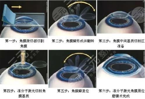 眼睛手術(shù)費用一覽表(眼睛手術(shù)費用一覽表北京同仁眼科醫(yī)院地址)