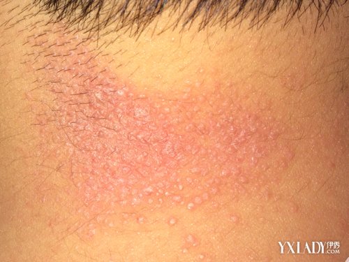 神經性皮炎怎么除根（頑固神經性皮炎怎么除根）