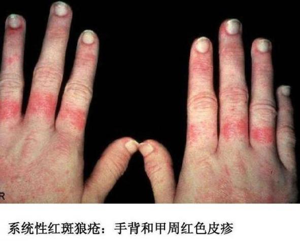 我得了紅斑狼瘡自愈了(我得了紅斑狼瘡自愈了會復發嗎)