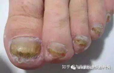 灰指甲用手摸了會傳染嗎(灰指甲手摸過的東西有真菌嗎)