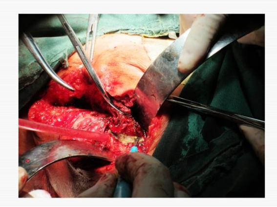 肛瘺手術盡量不做(肛瘺不做手術會怎么樣)