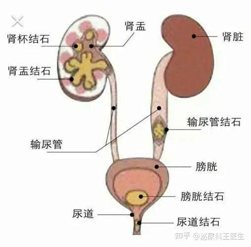 男性尿結石最快的排出方法(男性尿結石怎么處理)