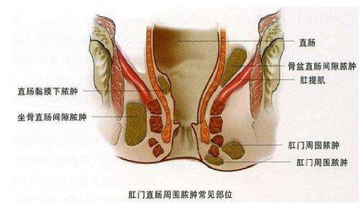 肛瘺啥癥狀怎么治療(肛瘺的癥狀及治療)