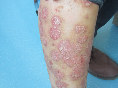 各類皮膚病圖片大全(各種皮膚病圖片對照圖)