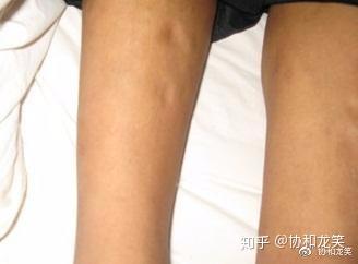 淋巴結是什么病嚴重嗎(肺部淋巴結是什么病嚴重嗎)