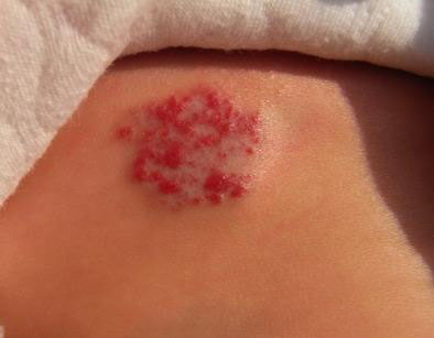 血管瘤是什么病嚴重嗎(脊椎血管瘤是什么病嚴重嗎)