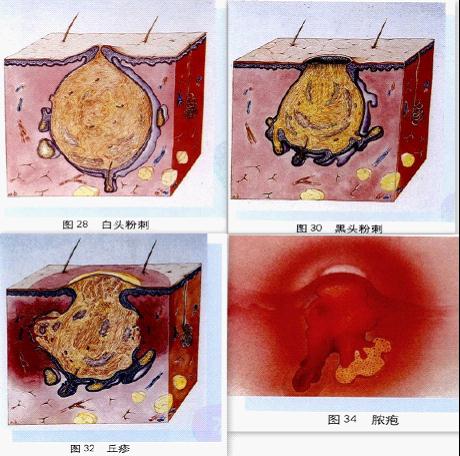 下面腥臭味一放甲硝唑就好(用了甲硝唑后里面長(zhǎng)滿了霉菌)