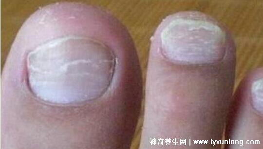 灰指甲圖片早期癥狀(紅霉素軟膏灰指甲最有效)