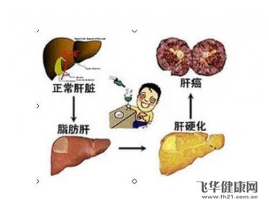 肝癌最直接的確認(rèn)方法(肝癌是如何確診的這3種常見的方法能及早發(fā)現(xiàn)病)