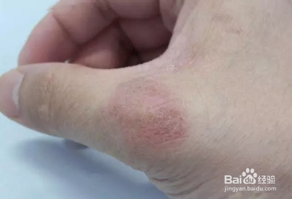 怎么判斷是不是疥瘡(怎么判斷是不是疥瘡和濕疹)