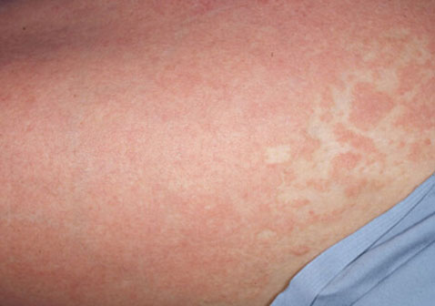 牛皮皮癬早期怎么控制(牛皮皮癬早期怎么控制北京仲博中醫(yī)醫(yī)院好不好)