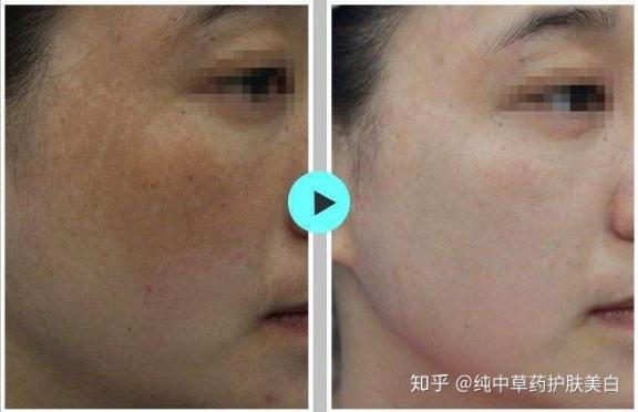 激光祛斑多少錢一次?(三甲醫(yī)院激光祛斑多少錢一次)