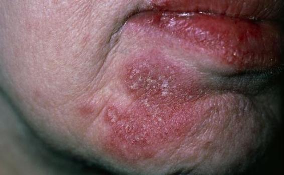 紅斑狼瘡最初癥狀圖片（紅斑狼瘡最初癥狀圖片脖子）