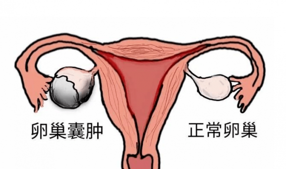 卵巢囊腫是怎么引起的(卵巢囊腫是怎么引起的怎么治療)