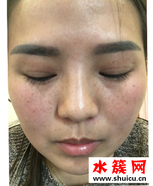 怎樣祛斑？激光祛斑后悔死了