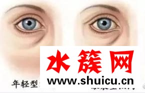 去眼袋多久恢復 去眼袋出現淤血怎么辦 去眼袋多久恢復