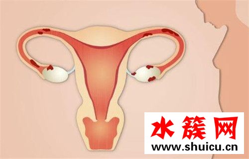 卵巢癌是什么原因引起的